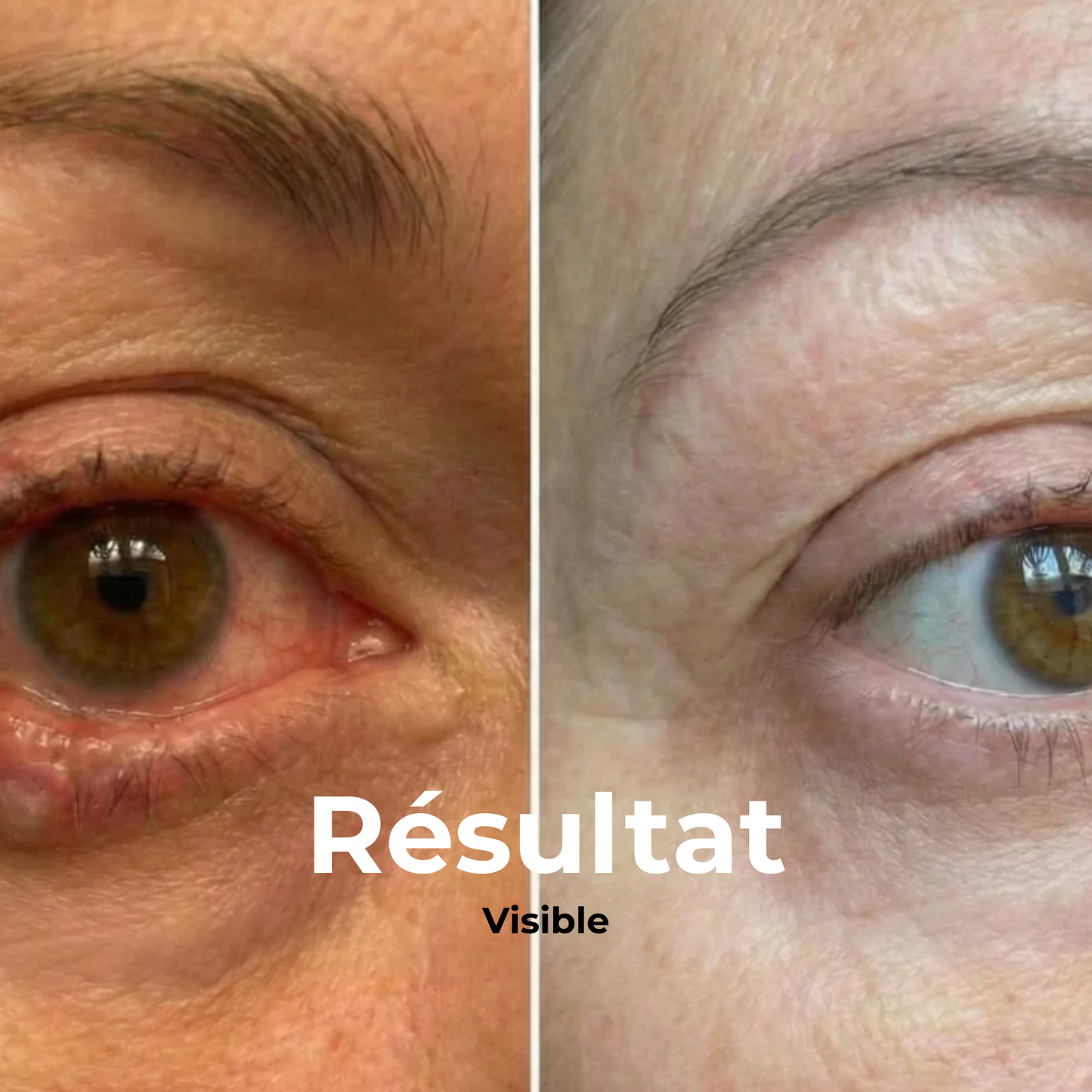 VapOculaire™ - Buse vapeur pour hydrater les yeux secs et le visage